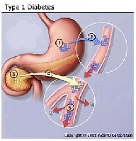 Insuline suikerziekte